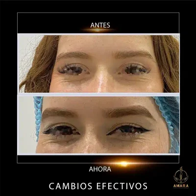 antes-y-despues-Ojos-Diana-Rios.webp