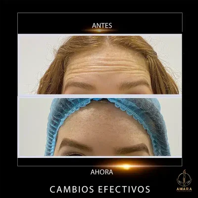 antes-y-despues-frente-Diana-Rios.webp