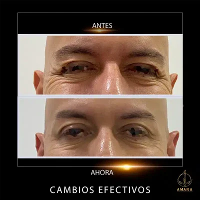 antes-y-despues-ojos-Cesar-Correa.webp