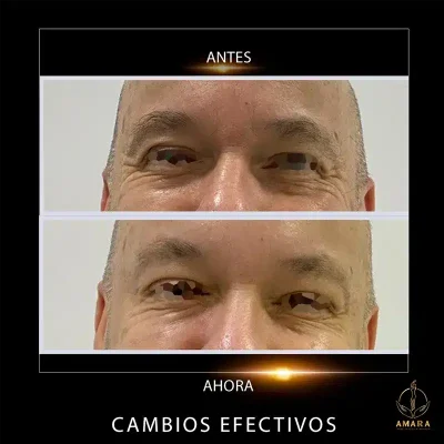 antes-y-despues-ojos-Juan-Carlos-Ospina.webp