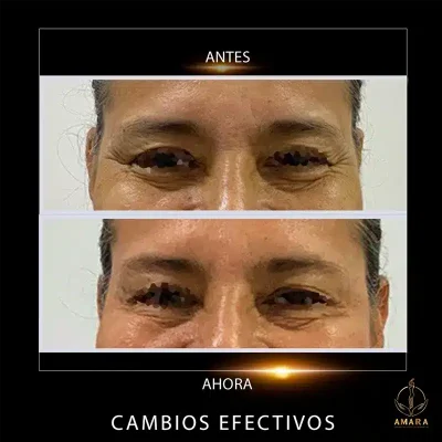 antes-y-despues-ojos-Liliana-Maria-Hernandez.webp